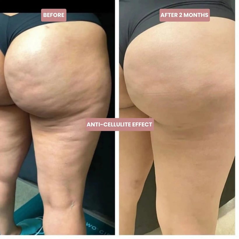 Before and after 2 months, anti-cellulite effect