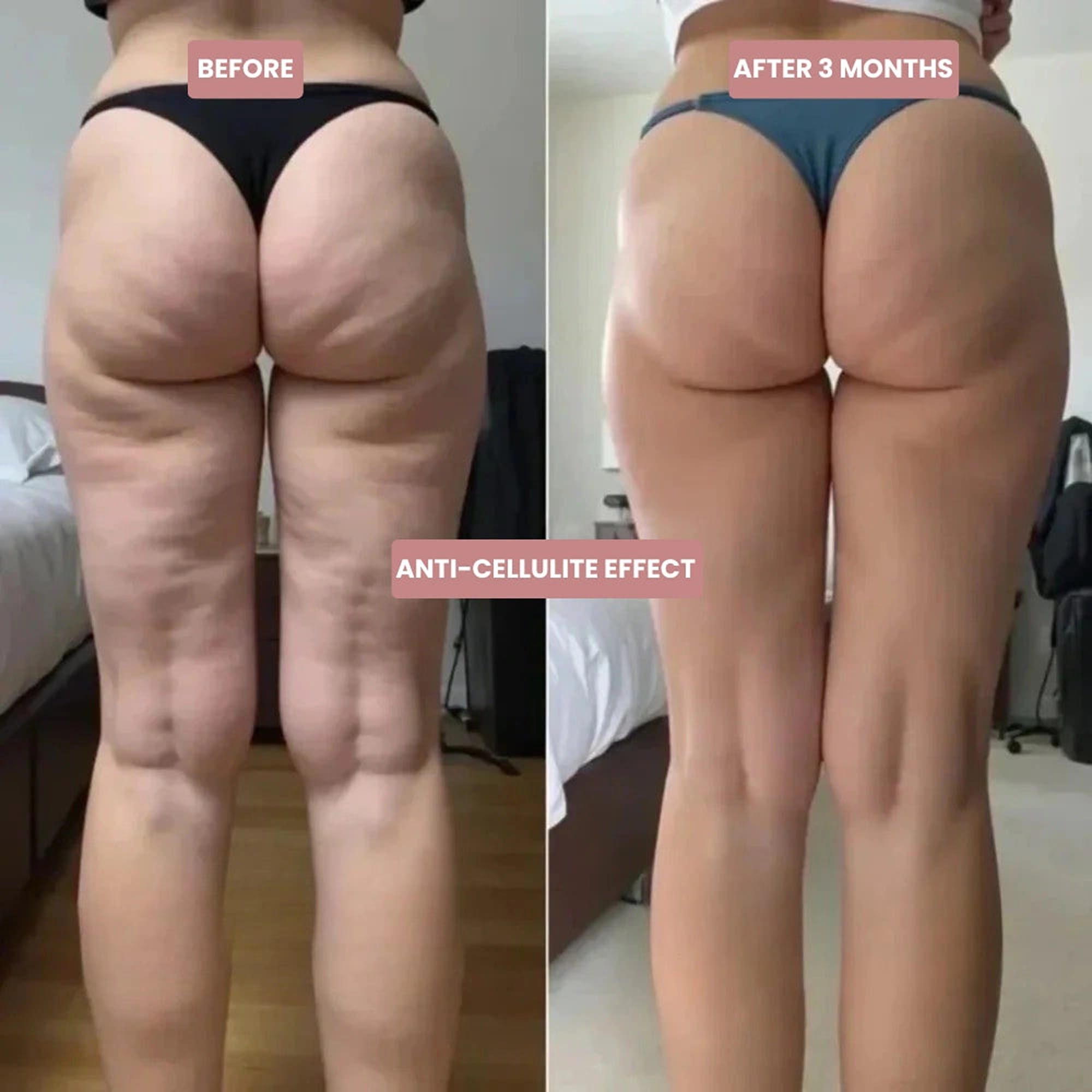 Before and after 3 months, anti-cellulite effect